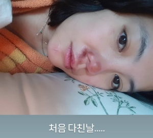 '코 재수술' <b>고은아</b>, 코에 또 피멍? "얼굴로 먹고사는데…"